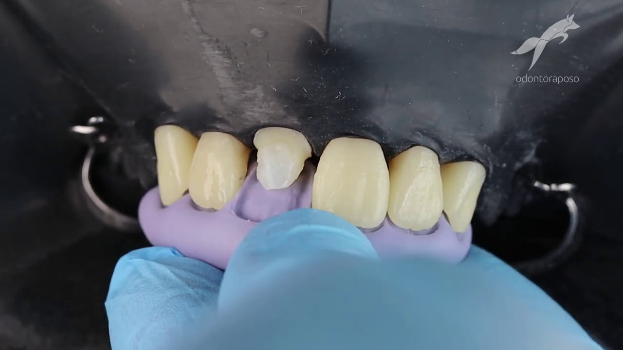 Reconstrução com Pino de Fibra + Resina Composta