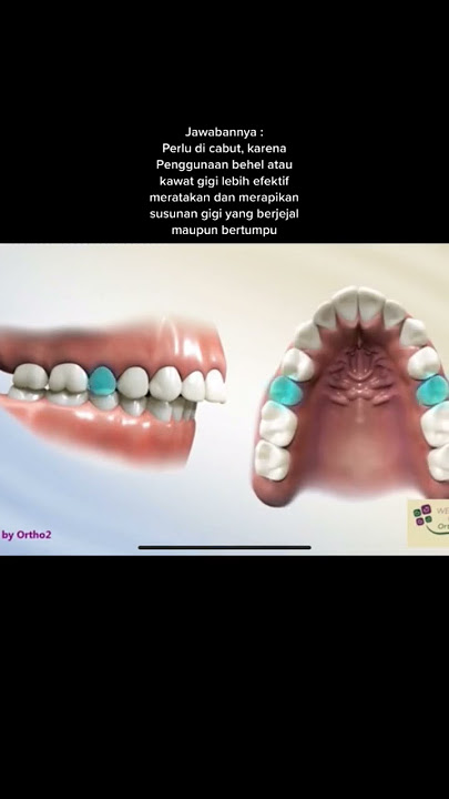 Haruskah cabut gigi sebelum pasang behel?,,,yuk lihat dulu videonya #doktergigi #smilereadybali