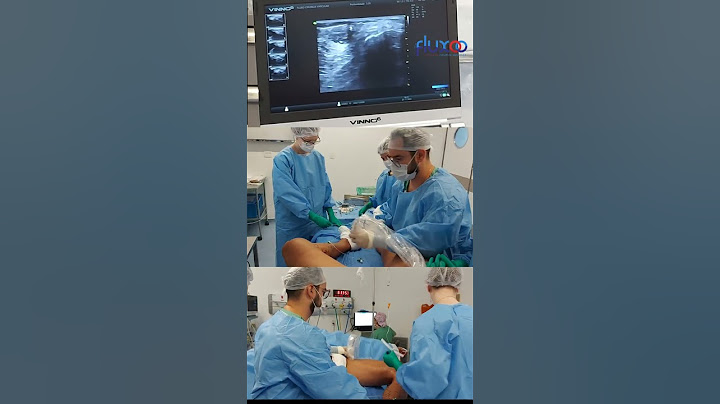 Cirurgia de Varizes a LASER - Equipe Fluxo de Cirurgia Vascular #shorts