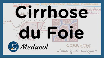 Est-ce qu'une cirrhose du foie se soigne ?