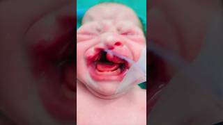 cleft lip and cleft palete New born baby bscnursingGNM nursingviral