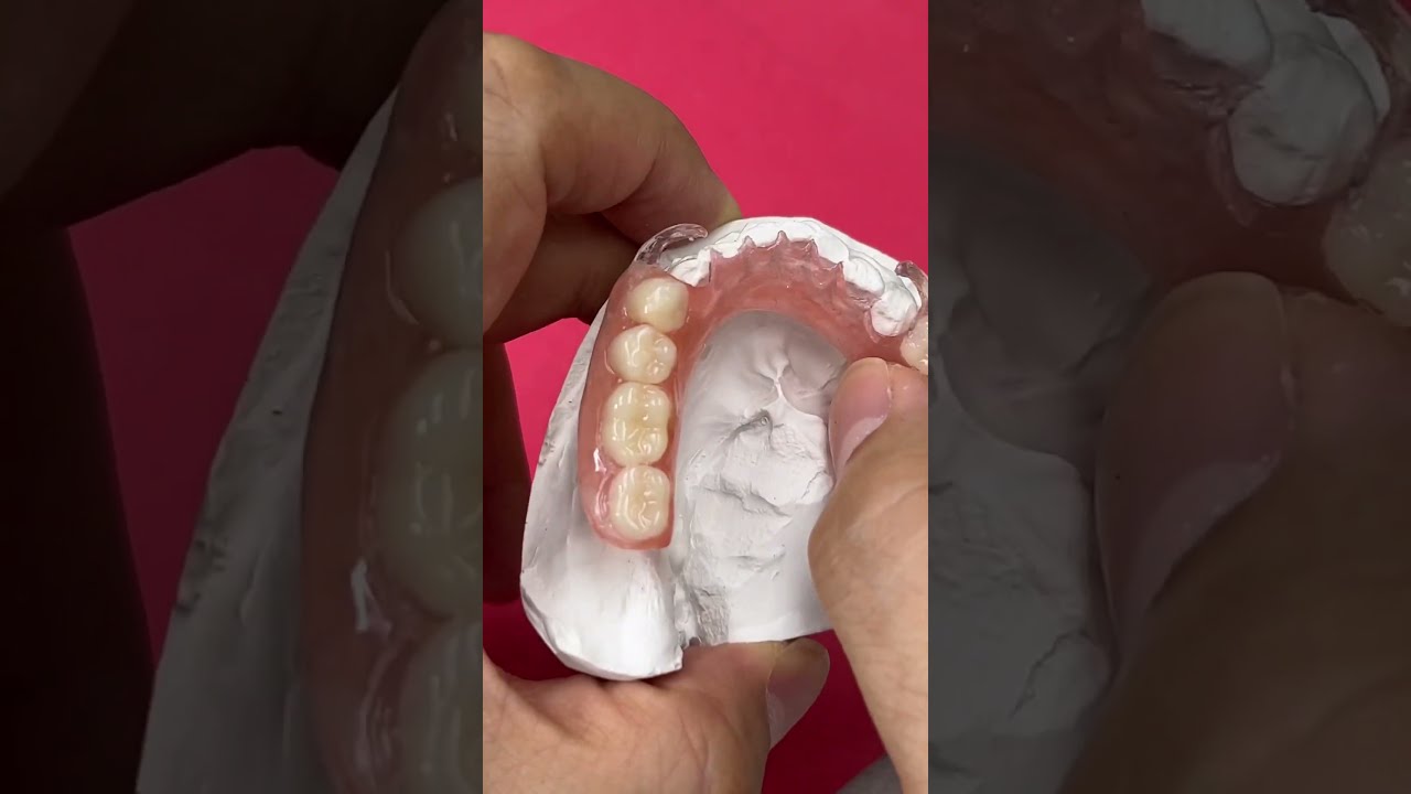 Replacing The Old Partial With A FiberFlex