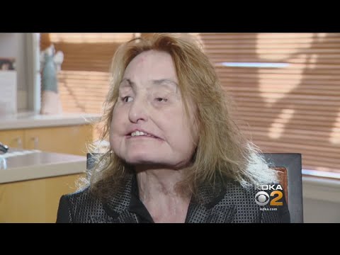 Video: The Woman Who Was The First In The United States To Receive A Face Transplant Dies