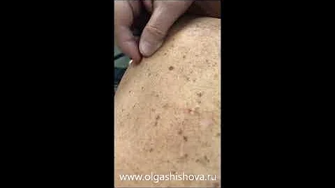 пациенты с трихинеллезом