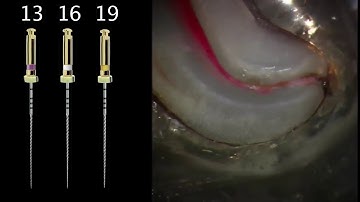 PathFile® - Dr. Gutmann | Dentsply Sirona