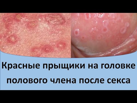 Красные прыщики на головке полового члена после секса