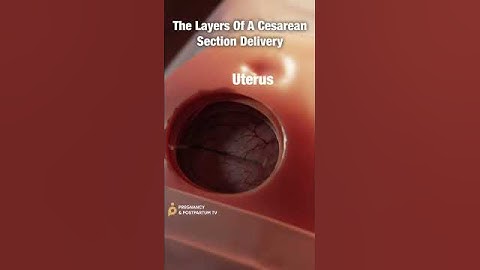Beautiful Breech C-Section Delivery #shorts