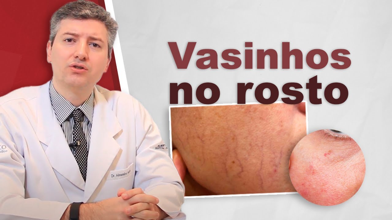 vasos sanguineos dilatados no rosto