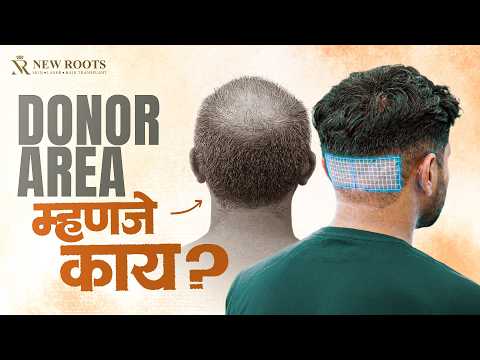 Donor Area: The Secret Behind Every Hair Transplant 🤔 | New Roots Nashik | Marathi