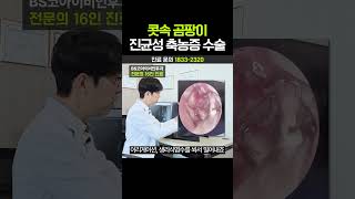 콧속 곰팡이 진균성 축농증 수술??