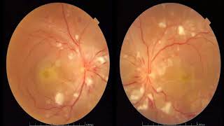 Approach to Abnormal Fundus Examination