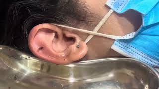 Safe Extraction of Heaped Ear Wax Restores Hearing and Comfort.