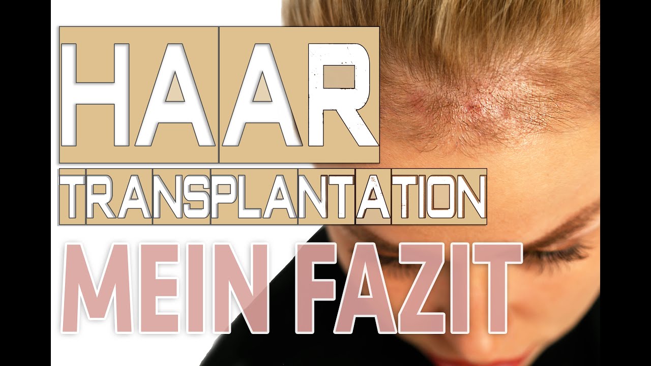 Haartransplantation erfahrungen frau