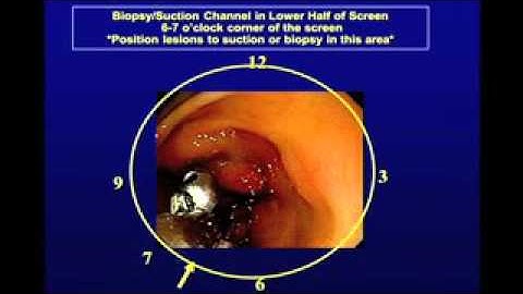 Tips and Tricks for Teaching Upper and Lower GI Endoscopy