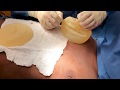 Silicone Implant Exchange with Dr. Ginsberg