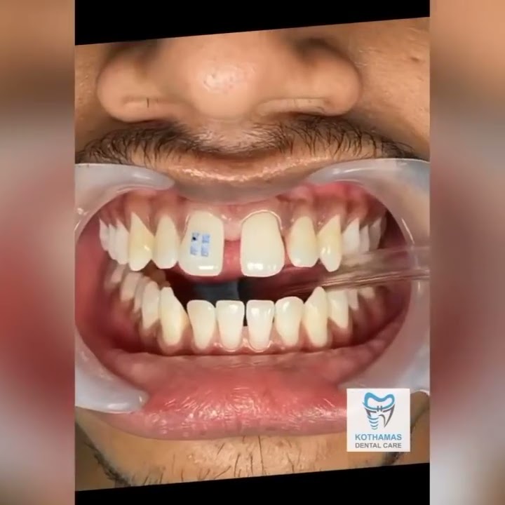 How braces are put on - Crystal clear braces #shorts