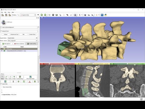 How to segment multiple vertebrae in spine CT for 3D printing