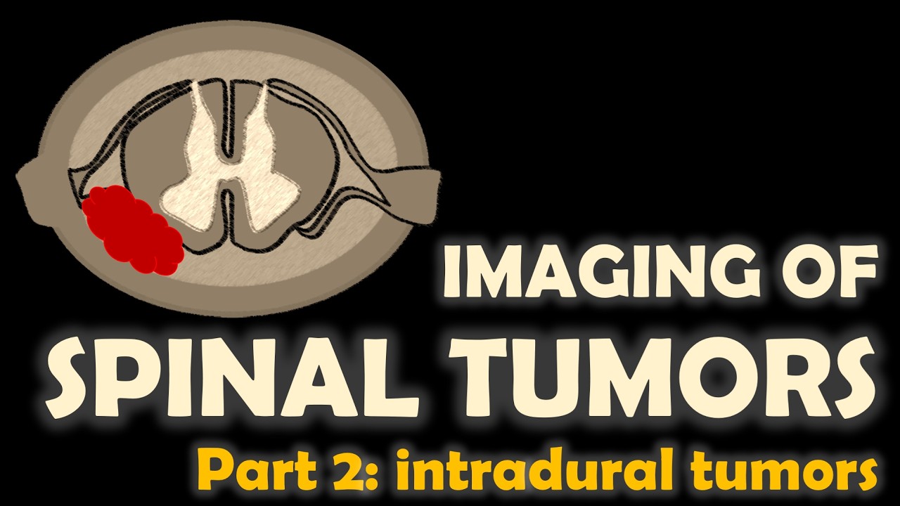 Imaging of spinal tumors, part 2: Intradural extramedullary spinal tumors