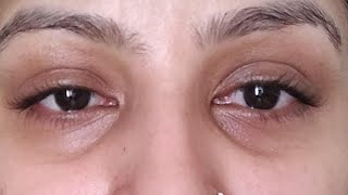 how to get rid of dark circles under your eyes in 3 minutes