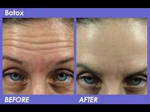 How To Remove Fine Lines On Forehead Naturally How To Remove Fine Lines On Forehead Naturally