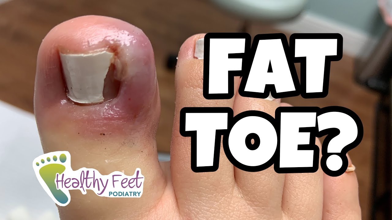 Ingrown Nail From a Fat Toe 