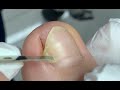 Sunken under toenail, What a satisfying nail removal video.