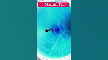 Macular Pathology | macular scar | Fundus Videography | Fundus Photography | Short Video 201  #viral