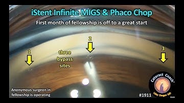 CataractCoach™ 1911: iStent infinite MIGS and phaco chop