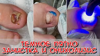 Темное пятно / Зачистка онихолизиса / Онихолизис на ноге / Что с ногтем? Что делать?