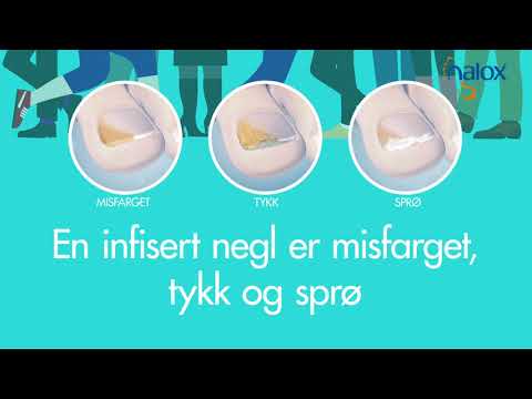 Video: Hvordan behandle tåneglssopp