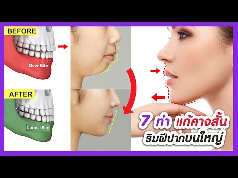 วีดีโอ: 7 วิธีในการแก้ไข Overbite