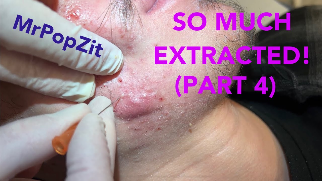 So much extracted! Severe acne before and after. Session 2. Comedones for days