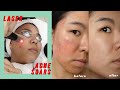 Picosure Laser for Acne Scars & Hyperpigmentation: Before & After