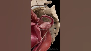 🎗 Ovarian Cancer: The Silent Threat 🎗 #medicalanimation #anatomy
