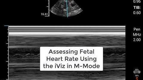 FHR Using M Mode with iViz Survival Flight Tutorial