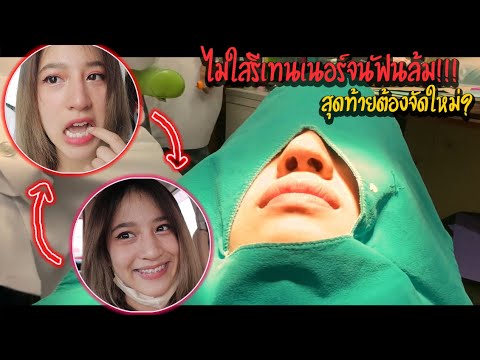 การ เลือก สี ยาง จัด ฟัน  New  VLOG : จัดฟันรอบ2 ขั้นตอนแรกยันใส่เหล็ก และบอกความรู้สึกของรอบ2 ฉันฟันล้ม ทุกคนรู้😭