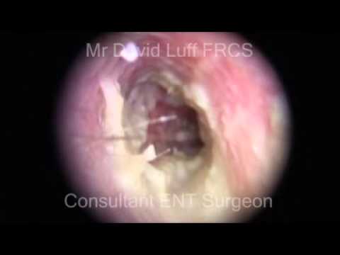 Otitis Externa Right Side Youtube