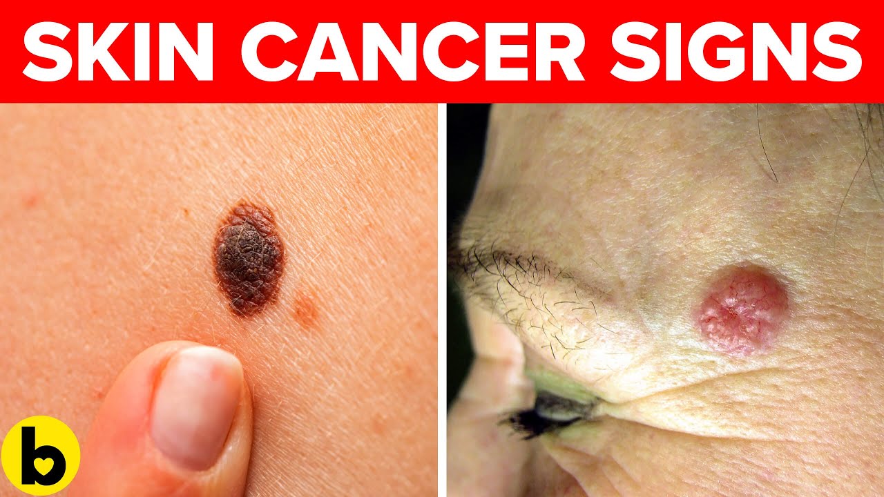 Early Skin Cancer Signs You Must Watch Out For - YouTube