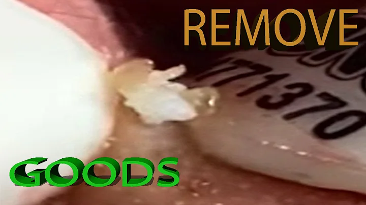 Remove blackhead# The Nose Knows Mr Wilson's Blackhead Extractions [Remove Blackhead] Spa Part#46