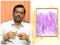 Doctor care - Intestine Ulcer Symptoms And Treatment Part 1