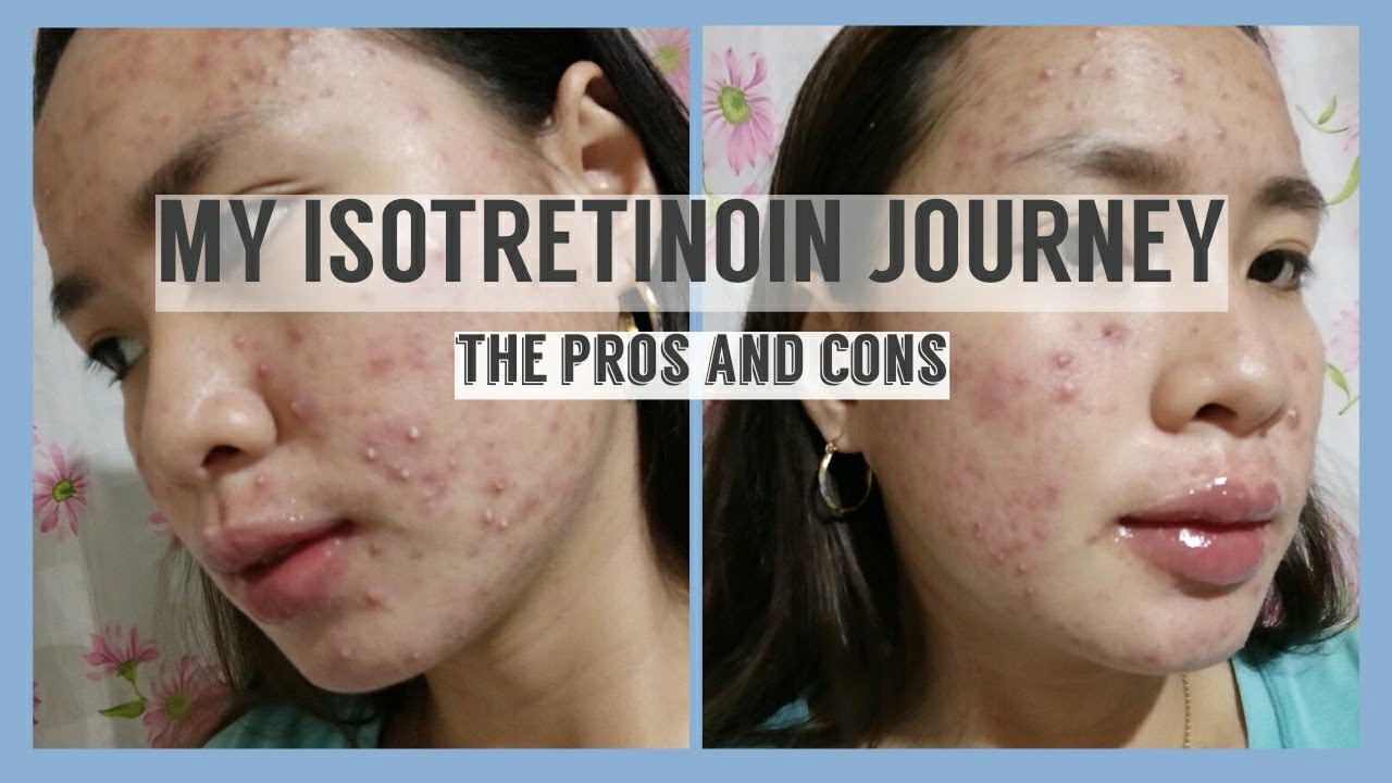 isotretinoin journey