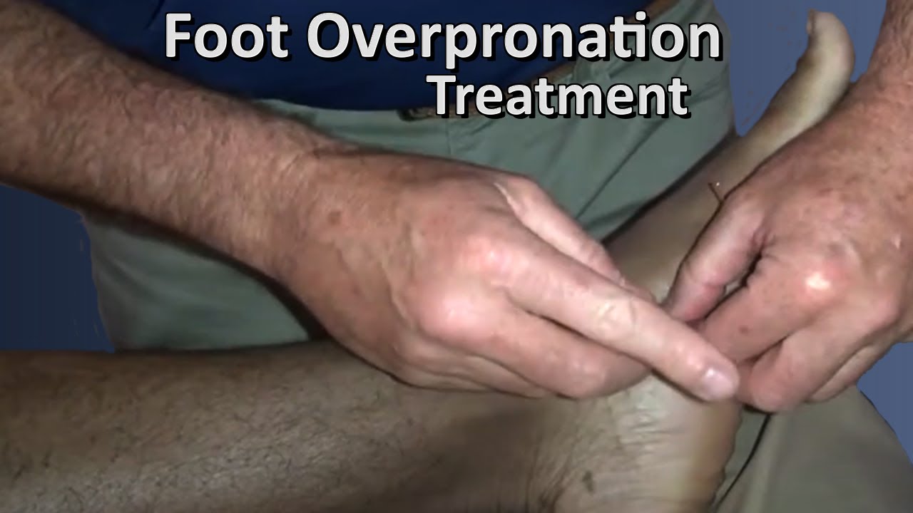 Acupuncture Treatment for Foot Over-Pronation