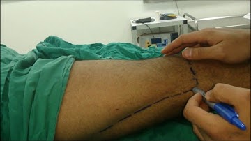 Lateral approach popliteal sciatic block - Peripheral nerve stimulator (PNS)