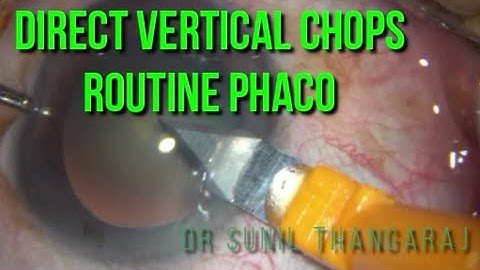 Routine phaco in a grade 3 Ns using quick chops