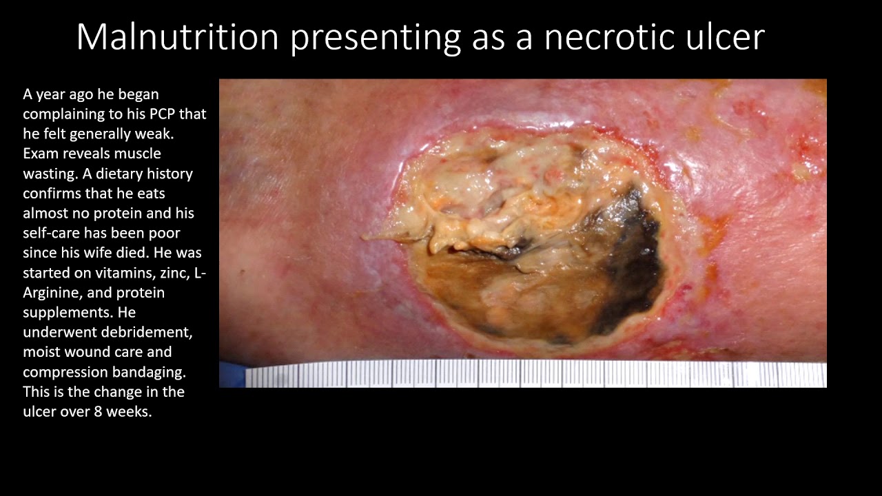 Malnutrition Presenting as a Necrotic Ulcer