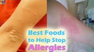 Top 10 Foods To Fight Allergy Naturally | Anti-Allergic Foods - 2017 NEW