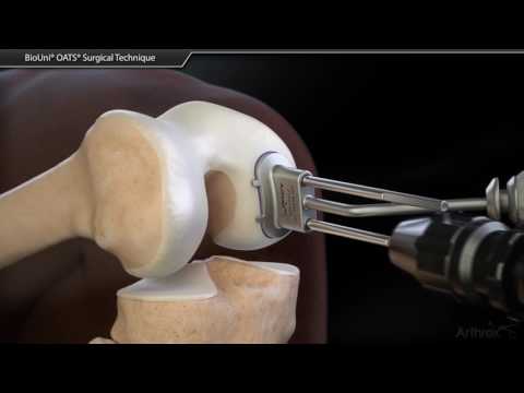 BioUni® OATS® Surgical Technique