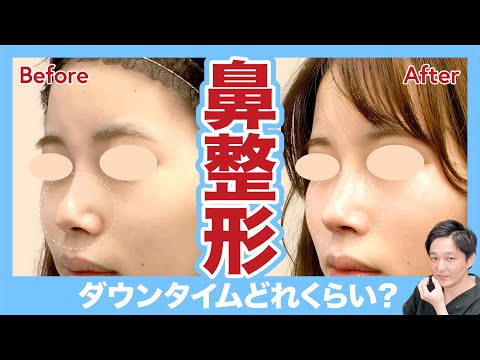 【鼻整形】術後のダウンタイム・過ごし方解説！【湘南美容クリニック】