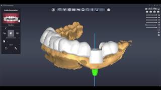Surgical Guide Sleeve Tube Extension Removal in TruAbutment Pylon Software