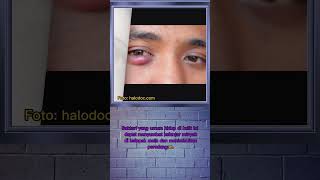 Apa Yang Menyebabkan Mata Binan?